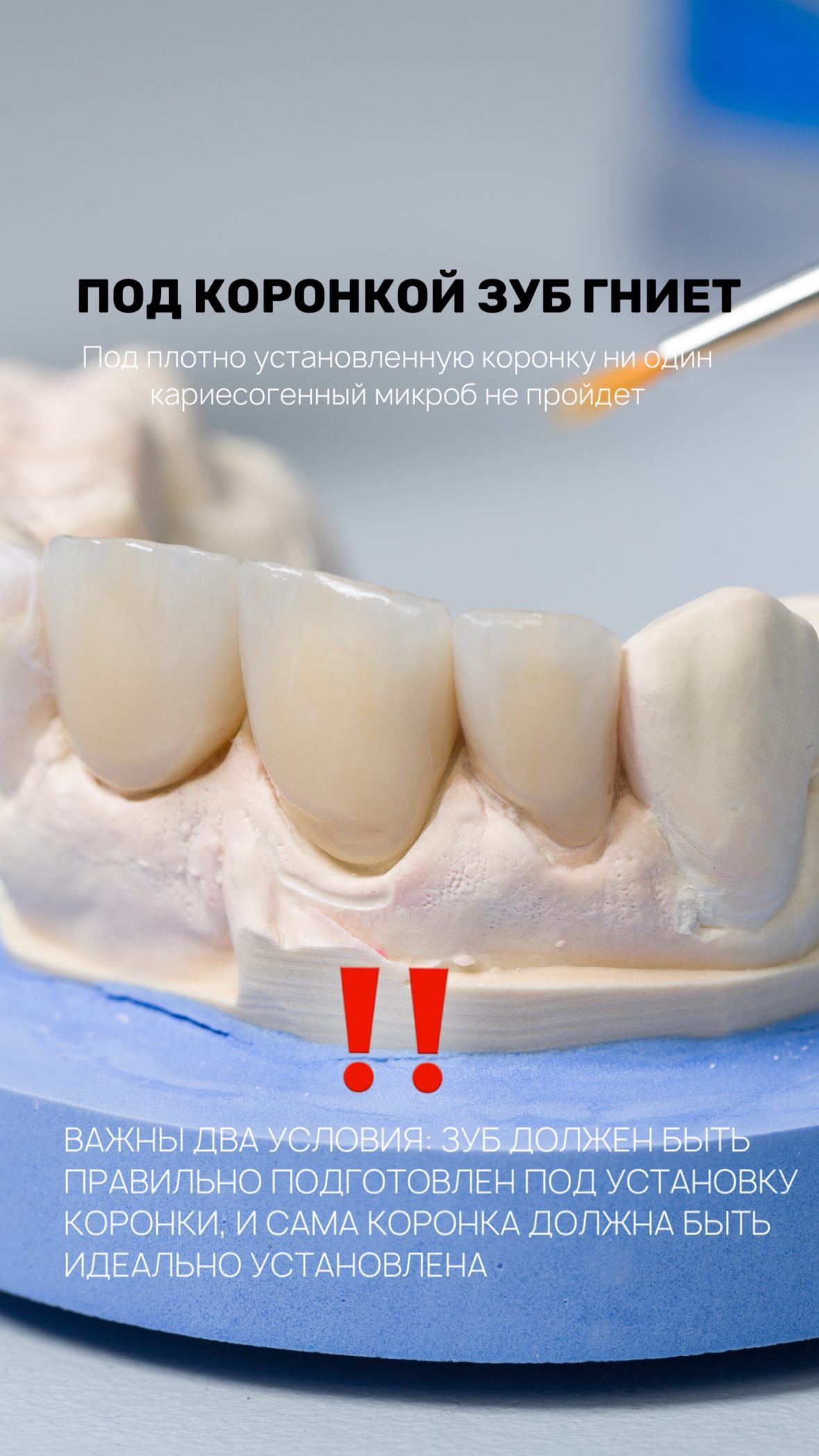 Коронки — работа 2