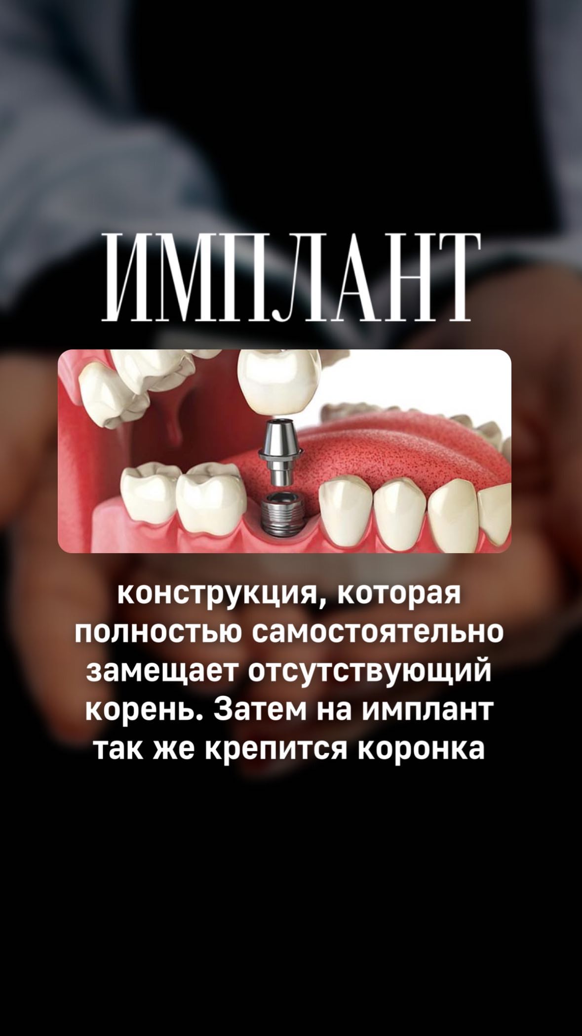 Имплантация — работа 5